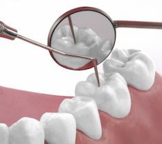 Tooth Cavity Treatment Baltimore Dentist