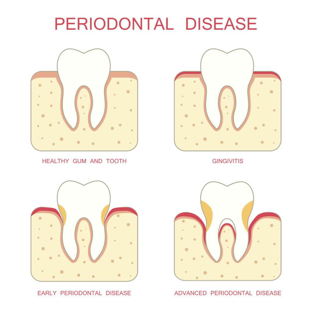 treatment for gum disease in Baltimore Maryland