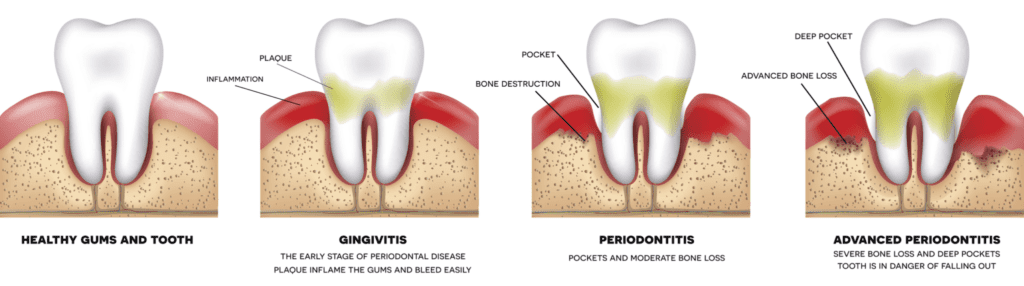 periodontal therapy in Baltimore MD