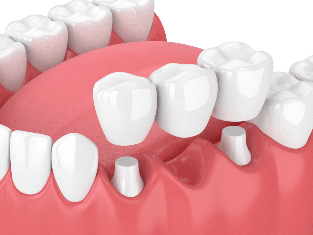 Dental Bridge treatment in Towson, MD