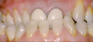 Full mouth rehabilitation in Baltimore MD