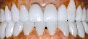 Full mouth rehabilitation in Baltimore MD