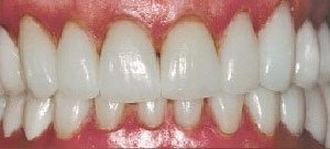 Full teeth restoration in Baltimore County MD