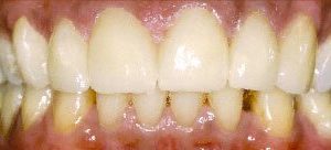Baltimore MD Porcelain Veneers for gaps in teeth