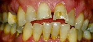 Crowns and veneers in Owings Mills MD