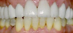 Crowns and veneers in Owings Mills MD