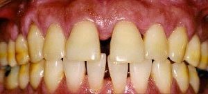 Porcelain veneers for smile makeover