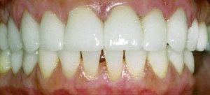 Porcelain veneers for smile makeover