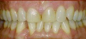 Porcelain Veneers in Owings Mills MD