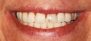 dental veneers for chipped and damaged teeth in Baltimore MD
