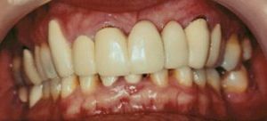 dental restorations in Baltimore MD at Cosmetic & Advanced Dentistry