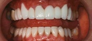 dental restorations in Baltimore MD at Cosmetic & Advanced Dentistry