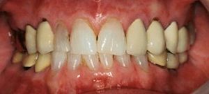 smile makeover in Baltimore County MD