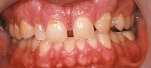 Porcelain veneers close gap between teeth in Owings Mills MD