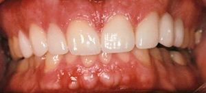 Porcelain veneers close gap between teeth in Owings Mills MD