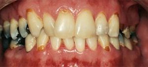 dental bridges replace damaged teeth in Baltimore MD