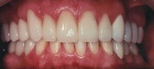 dental bridges replace damaged teeth in Baltimore MD
