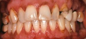 Root canal therapy in Owings Mills MD