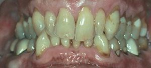 Dental crowns and veneers in Baltimore MD