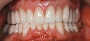 Dental crowns and veneers in Baltimore MD