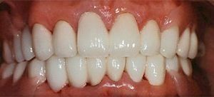 Replacing missing teeth in Baltimore MD