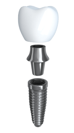 Dental Implant procedure in Baltimore MD