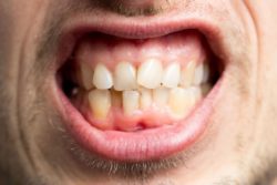 Why You Should Not Ignore Crooked Teeth