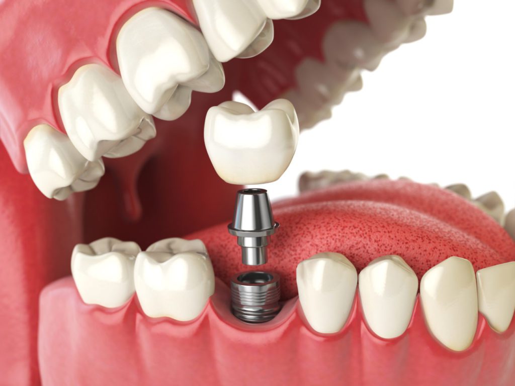 dental implant for one tooth in Baltimore Maryland