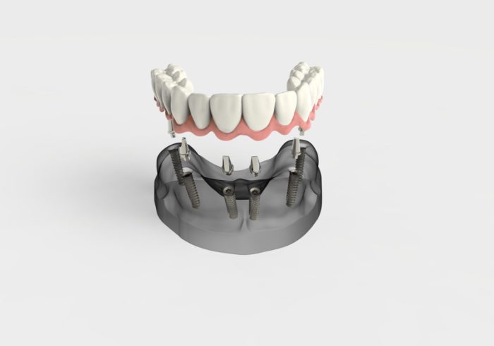 multiple teeth dental implants in Baltimore, MD
