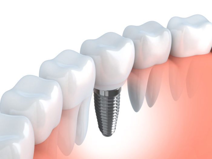 single dental implant in Baltimore