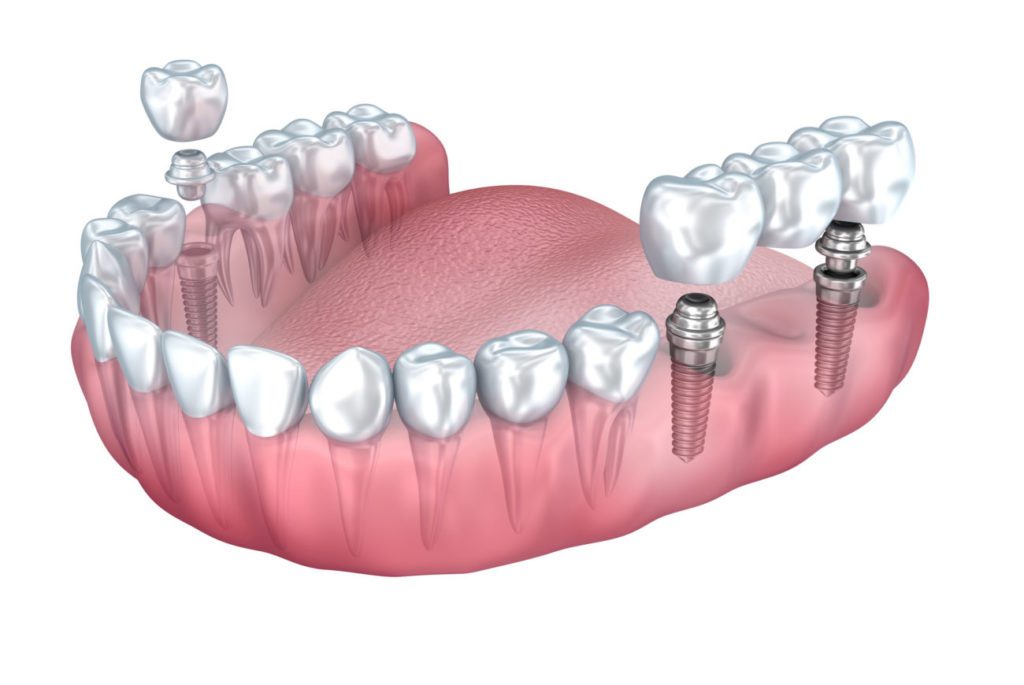 dental implant-supported bridge