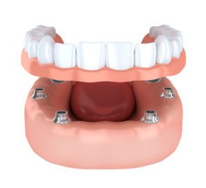 Implant Supported Dentures Baltimore Prosthodontist 