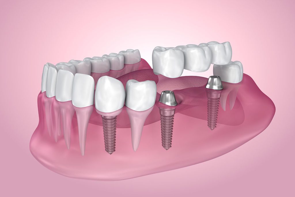 Dental Implants Could Be For You