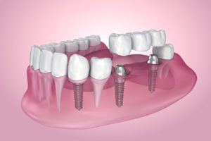 implant-supported dental bridge in Towson Maryland
