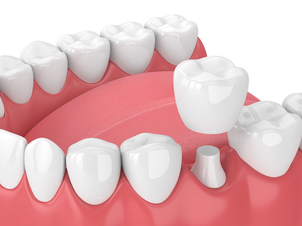 What Dental Crowns Can Do For You