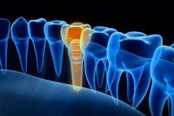 dental implants in baltimore, md