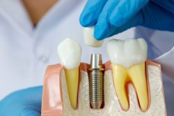 restorative dentist in baltimore, maryland