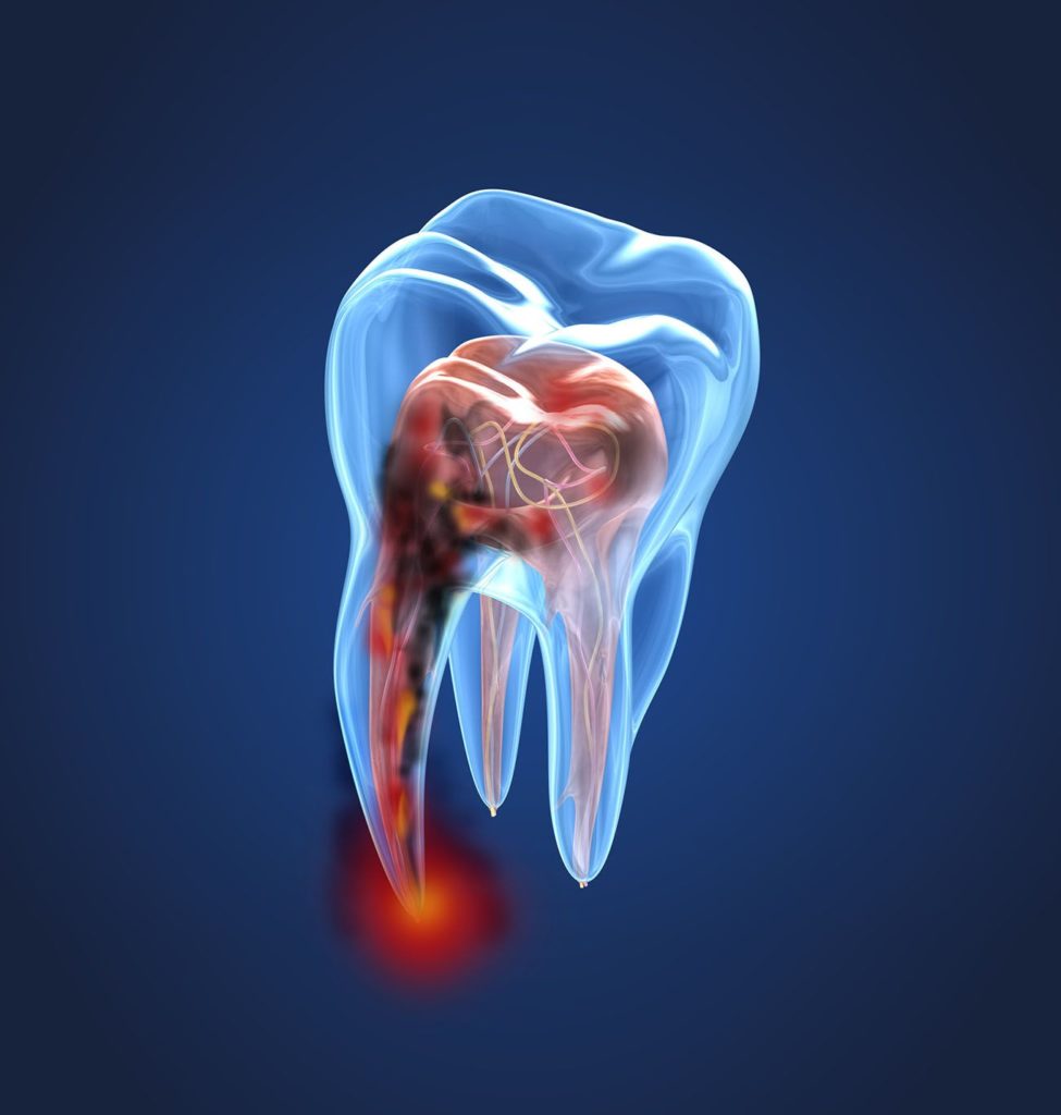 Root Canal in Towson, MD