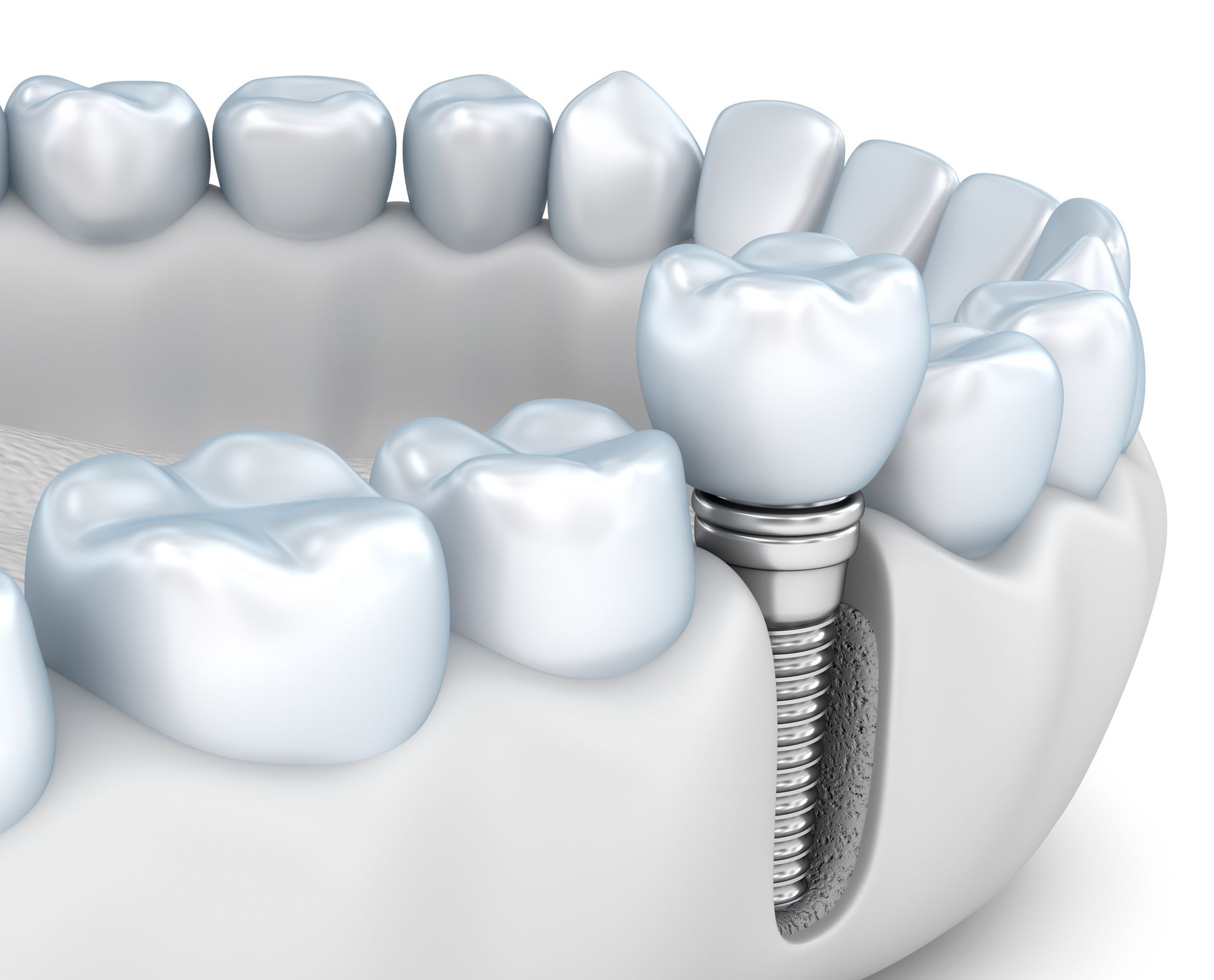 dental implants restore jawbone health in Baltimore Maryland