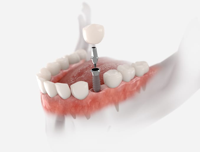 Implant-secured dental crown