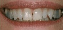 Before cosmetic dentistry in Baltimore, MD
