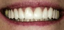 After cosmetic dentistry in Baltimore, MD