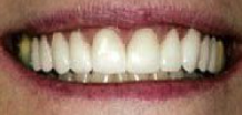 After cosmetic dentistry in Baltimore, MD