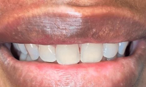 Before cosmetic dentistry in Baltimore, MD