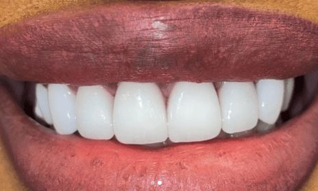 After cosmetic dentistry in Baltimore, MD