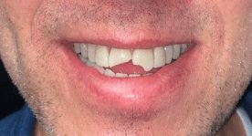 Before cosmetic dentistry in Baltimore, MD