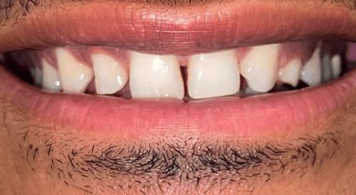 Before cosmetic dentistry in Baltimore, MD