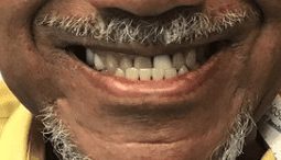 Before cosmetic dentistry in Baltimore, MD