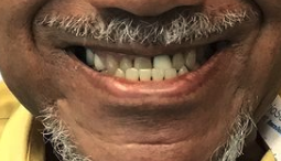 Before cosmetic dentistry in Baltimore, MD