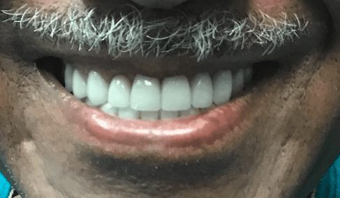 After cosmetic dentistry in Baltimore, MD